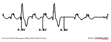 Palpitation Electrocardiogram Wikidoc