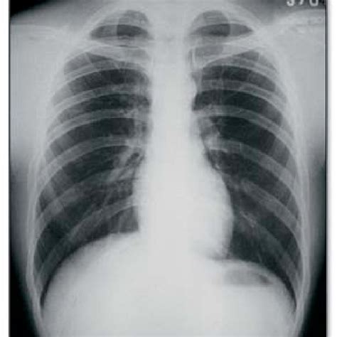 Pdf Primary Tuberculosis Of The Tongue A Case Report