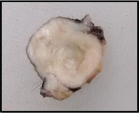 Dermatofibrosarcoma Protuberans Of The Scalp With Fibrosarcomatous