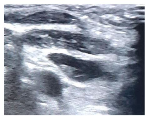 Usg Image Of Parathyroid Adenoma Primary Hyperparathyroidism Phpt