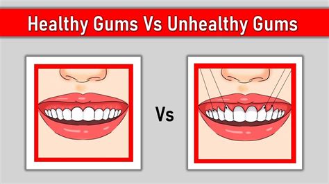 Receding Gums How To Get Healthy Gums Naturally At Home Youtube