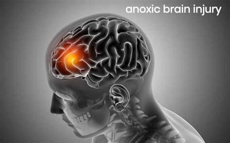 Anoxic Brain Injury Causes Symptoms Treatment Recovery Abtc
