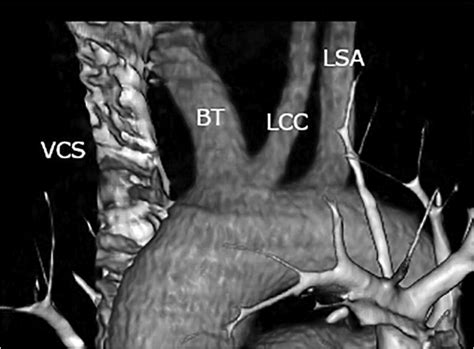 Bovine Aortic Arch Type A The Bt And Lcc Share A V Shaped Common