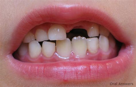 Adults With Baby Teeth Still TeethWalls