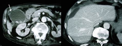 Successful Non Operative Management Of Spontaneous Type Ii Gallbladder