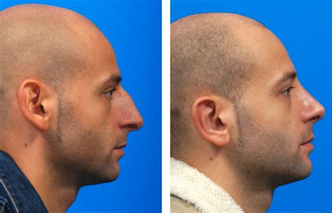 Nasenkorrektur Rhinoplastik Nasen Operation