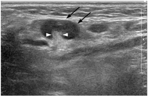 In The Normal Neck Using High Resolution Ultrasonography About Of Lymph Nodes With Maximum