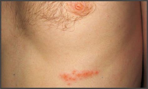 Pictures Of Shingles Rash Under Breast Shingles Expert