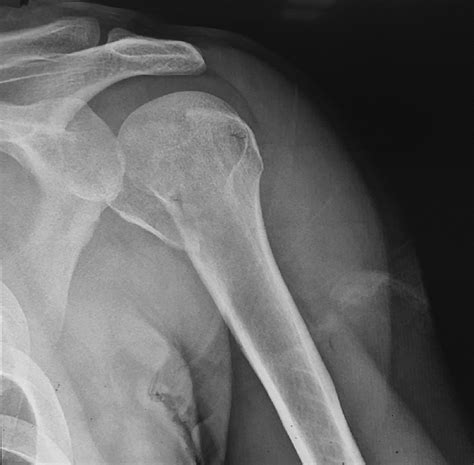 Shoulder Dislocations X Ray My Xxx Hot Girl