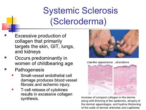 Scleroderma Myositis Support And Understanding