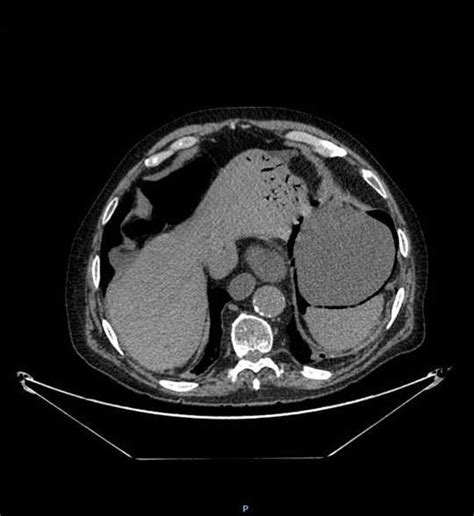 Axial View Of The Abdominal Ct Scan With Iv Contrast Medium Showing