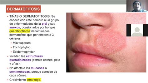 Ryan caballes f., sendi h., bonkovsky h. Micosis superficiales I -Micosis Superficiales II - YouTube