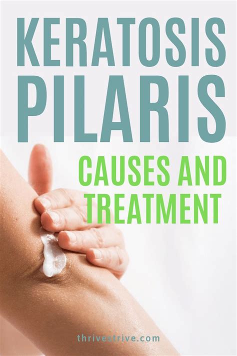 Keratosis Pilaris Causes And Treatment Of This Condition Keratosis