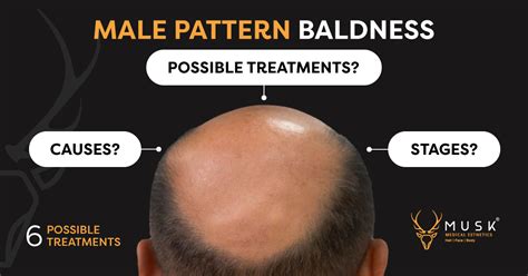 Male Pattern Baldness Causes Stages And Possible Treatments