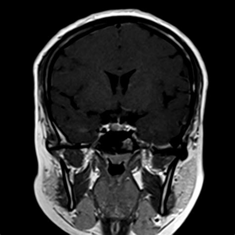 Pituitary Microadenoma Image