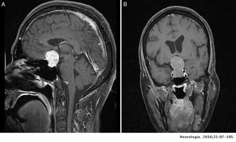 Atypical Pituitary Adenomas 10 Years Of Experience In A Reference