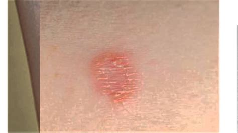 Cutaneous Candidiasis As Related To Dermatitis Pictures