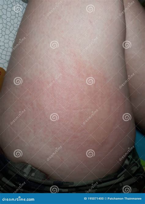 Skin On The Legs Psoriasis Rashes Eczema And Other Skin Conditions