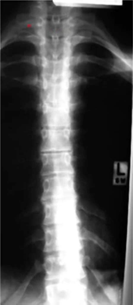 Medical Examination 1 Radiology Ap Thoracic Spine 1 Diagram Quizlet