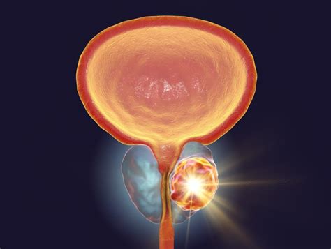 Thulium Trumps Holmium Laser Enucleation For Benign Prostate Hyperplasia Latest News For