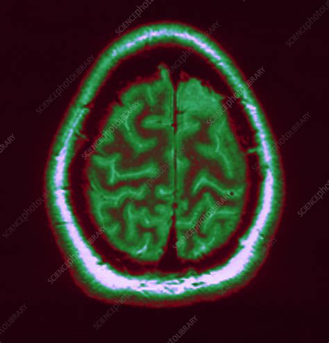 Mri Of Normal Brain Stock Image C0271007 Science Photo Library