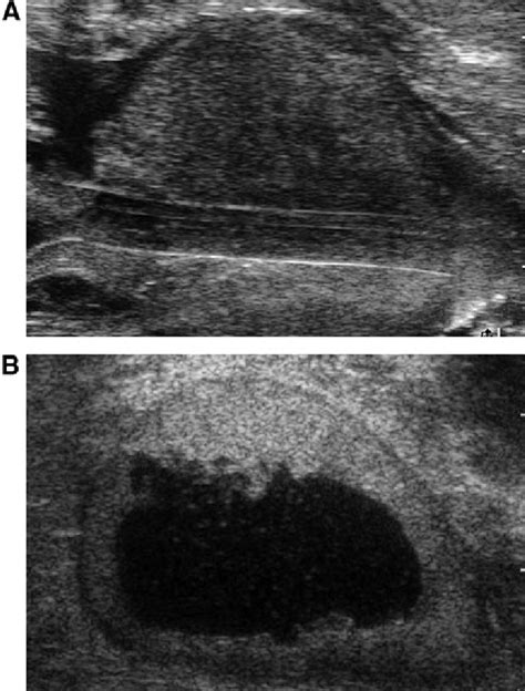 Transrectal Ultrasonography Of The Prostate A Before And B