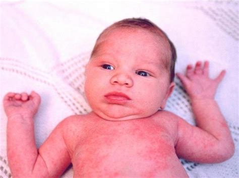 Heat Rash On Baby Face In Winter Baby Acne Eczema Heat Rash