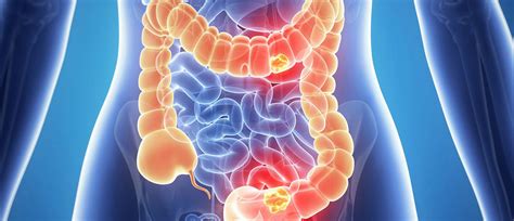 Improved Analysis Of Bowel Cancer Tumours Could Mean Better Outcomes York Press