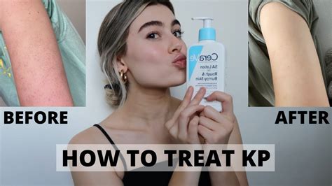 HOW TO GET RID OF KP ON ARMS KERATOSIS PILARIS YouTube