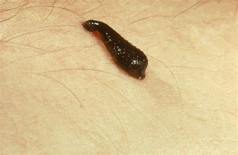 Leeches Are Most Active During Hot Days Heres What To Do