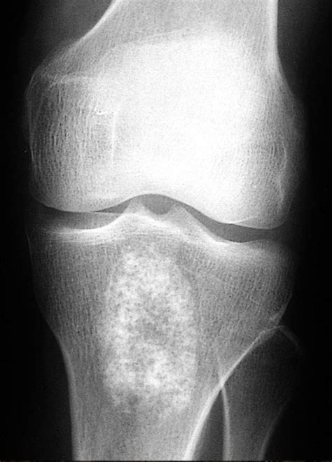 Pathology Outlines Enchondroma Of Long Bones