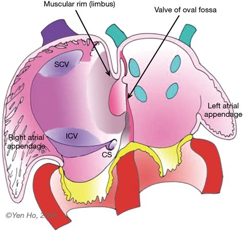 Anatomy Of The Atrial Septum And Interatrial Communications Naqvi