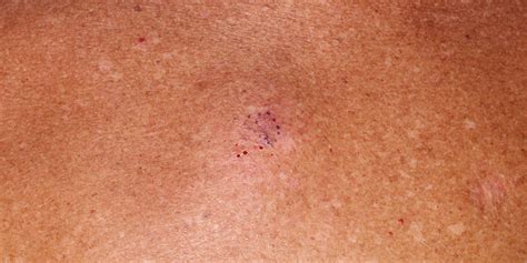 Melanoma In Situ Skin Cancer And Reconstructive Surgery Center