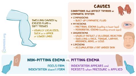 Non Pitting Edema What Is It Causes Diagnosis Treatment And More Osmosis