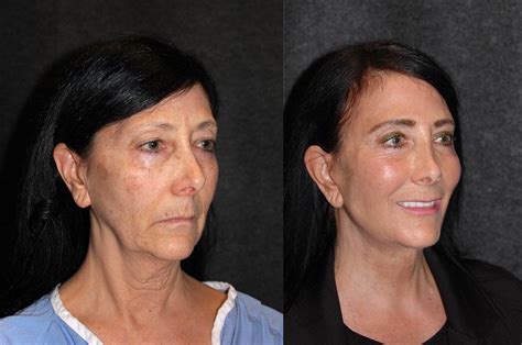 Deep Plane Facelift Before And After Dr Andrew Jacono Facial