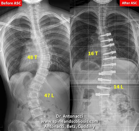 Scoliosis Curve