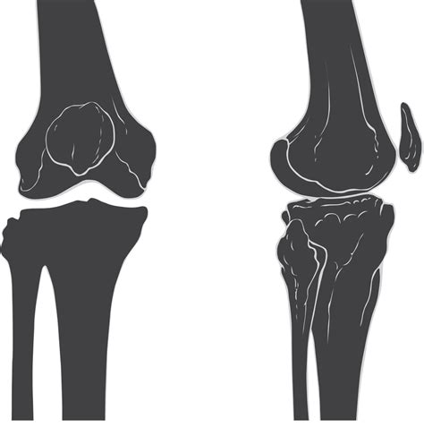 Collection Of Png Knee Pluspng