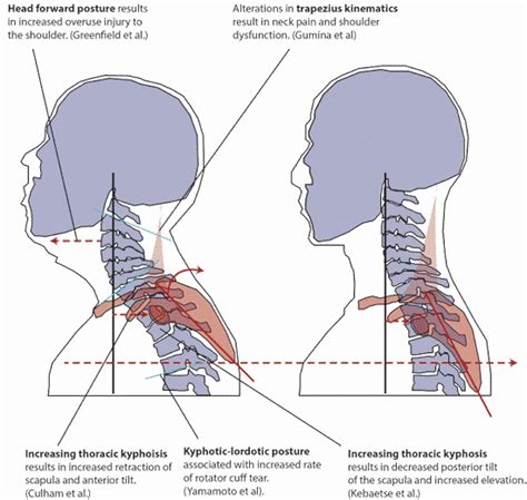 The Best Ways To Fix Forward Head Posture Nerd Neck
