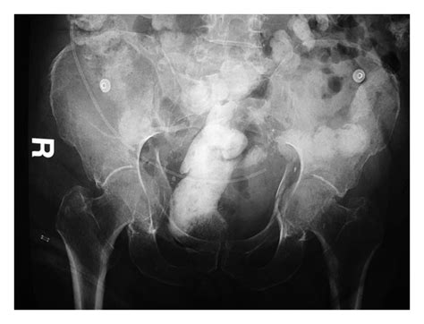 Ap Pelvis X Ray Showing Displaced Fractures Of Both Acetabuli With