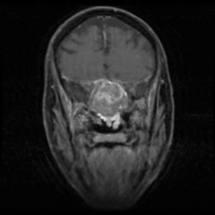 Sinonasal Mucosal Melanoma Radiology Reference Article Radiopaedia Org