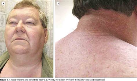 Figure 1 From Neck Pain Stiffness And Periorbital Edema In A Man With