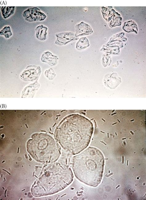 Urinalysis Basicmedical Key