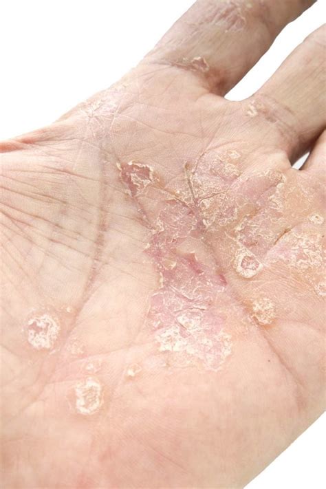 Psoriasis And Cancer Is There A Link