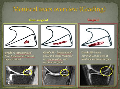 Grade Meniscus Tear Mri Hot Sex Picture