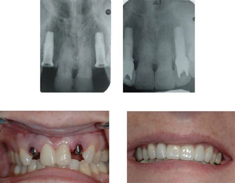 Dental Implants Before And After Dr Ari Greenspan Dentist