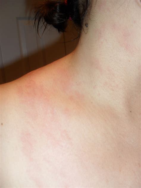 Red Hives And Welts On My Neck And Shoulder From Sodium Laureth Sulfate