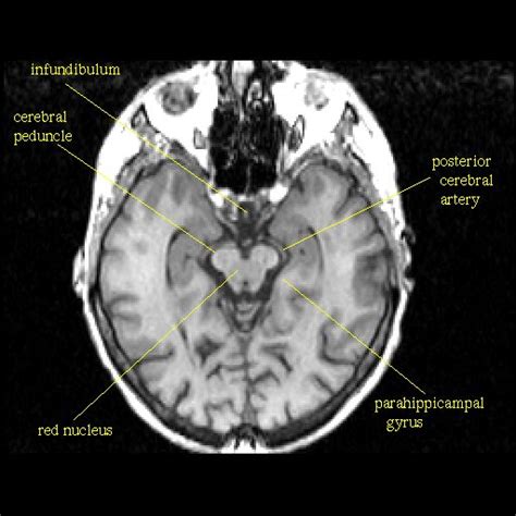082t2 512×512 Anatomy Radiology Imaging Brain Anatomy