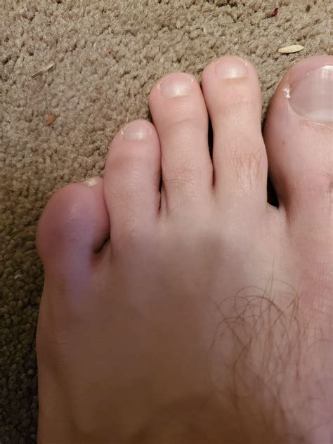 Can Anyone Tell Me What S Wrong With My Pinky Toe R Podiatry