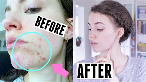 Video How I Cleared My Acne Before And After Pictures Hormonal Acne