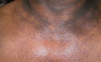 Dark Spots on Neck, Chest, Shoulder Causes and Cure - Skincarederm